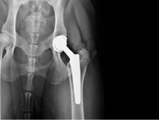 Joint Replacement