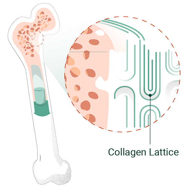  An illustrated diagram shows a cross-section of a bone. An inset bubble shows a magnified view of the bone structure, with an arrow pointing to a fine, interconnected network of fibers labeled as "Collagen Lattice."