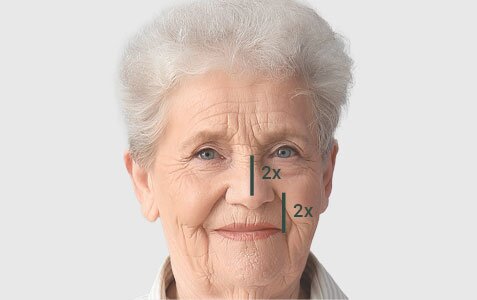 an older woman with a vertical black line showing the distance from the nose to the upper lip labeled "2x," and line from the base of the nose to the bridge also labeled "2x", indicating what aging does to facial proportions