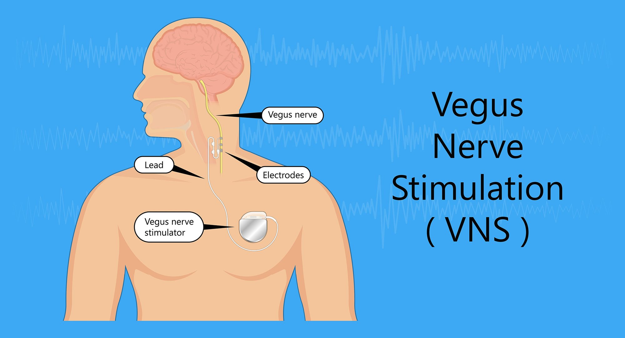 Air Force vagus nerve stimulation study 