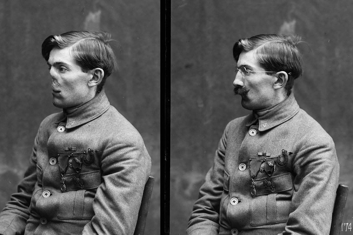 facial reconstruction WWI