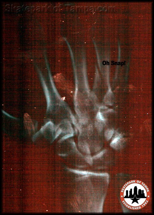 Rob Meronek's broken hand