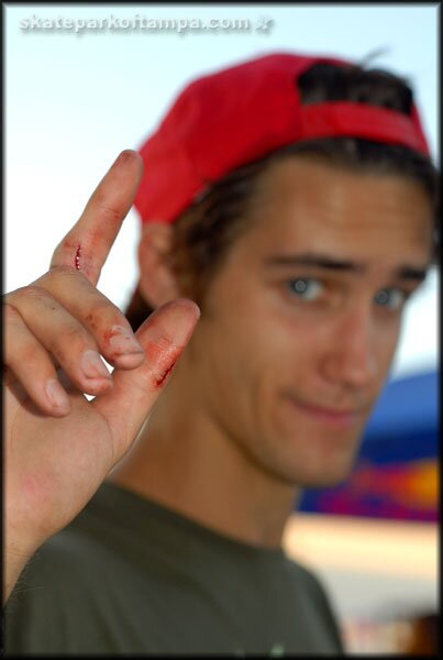 Dylan Perry got some stiching
