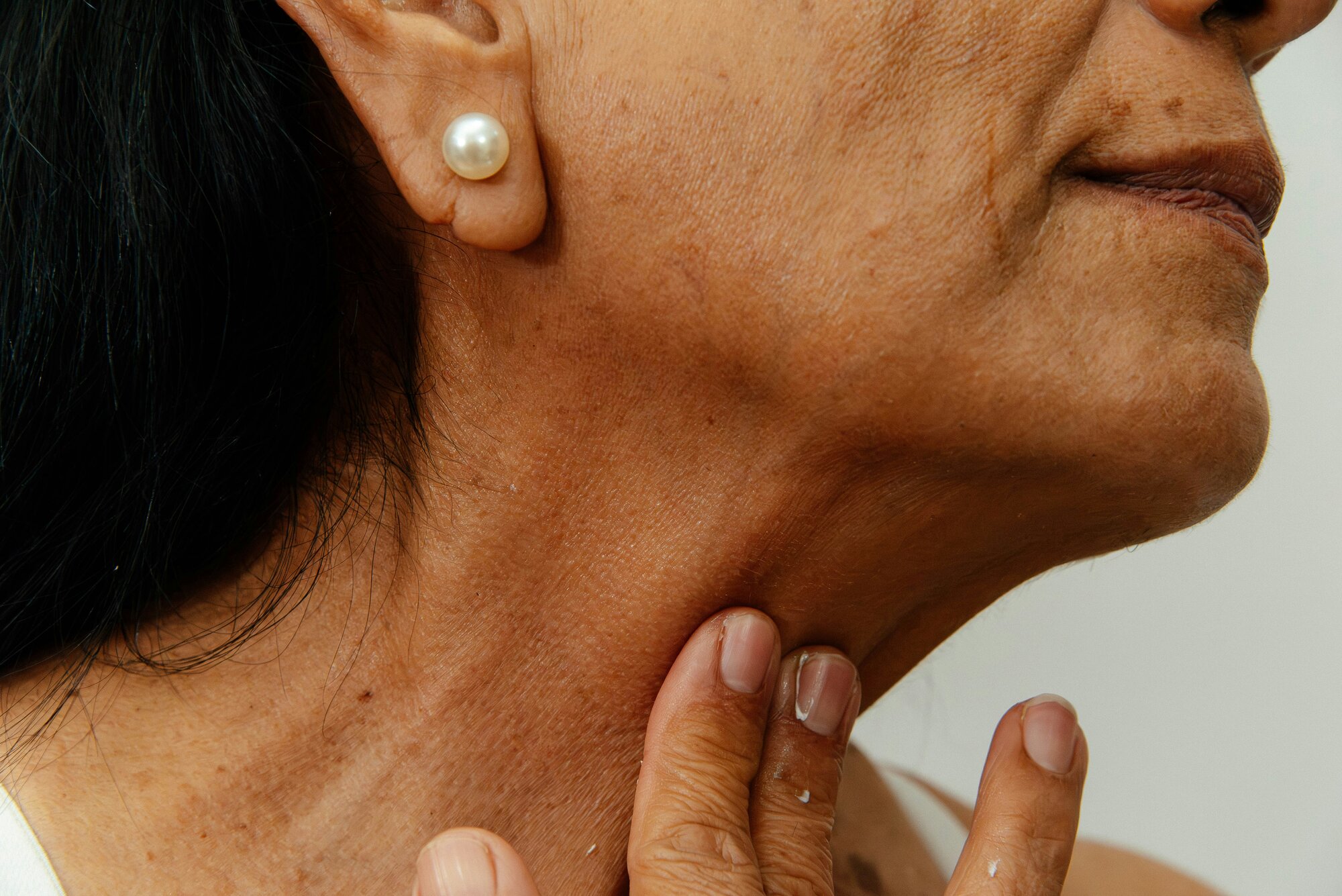 Hashimoto: Wenn das eigene Immunsystem die Schilddrüse bekämpft