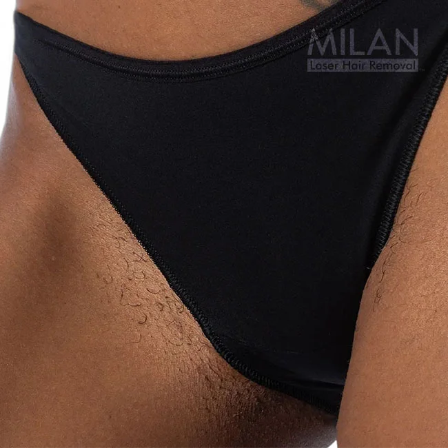 Close up image of a bikini area featuring a before image of a woman who's about to get bikini laser hair removal