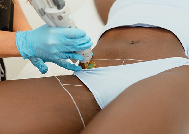 A woman in a light-blue outfit gets a laser hair removal treatment on her bikini line for a blog titled Laser Hair Removal For Sensitive Skin.