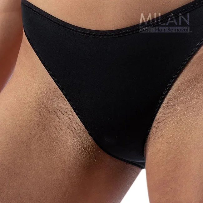 Close-up of a woman in a black bikini before she got bikini laser hair removal, on which you can see stubble
