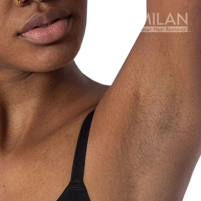 Model 4 after underarm laser hair removal