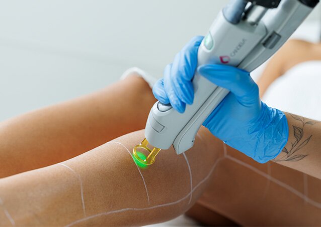 A woman receives a laser hair removal treatment on her legs from a Milan Laser Provider in an image for a blog titled Does Laser Hair Removal Work on Grey Hair?
