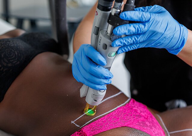 A woman wearing a black top and pink bottoms gets laser hair removal on her stomach from a Milan Provider in an image for a blog titled Can Laser Hair Removal Affect Fertility?