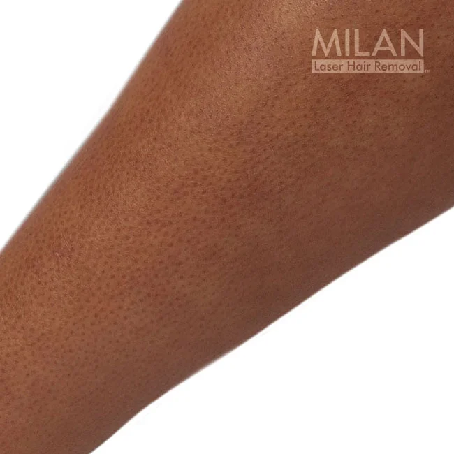 After image of a Milan client after leg laser hair removal