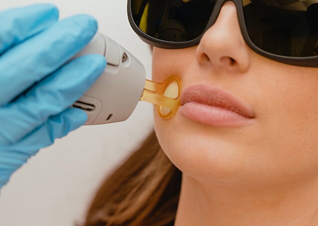 A woman wearing protective eyewear gets laser hair removal on her upper lip in an image for a blog titled Laser Hair Removal For Blonde Hair.