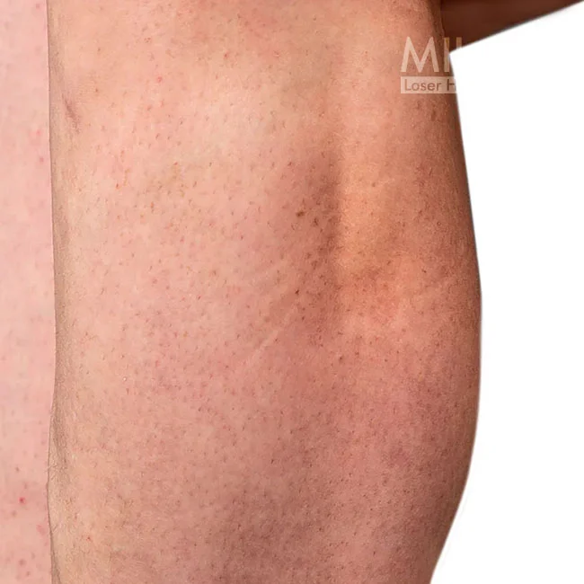 Before image of a Milan client before leg laser hair removal