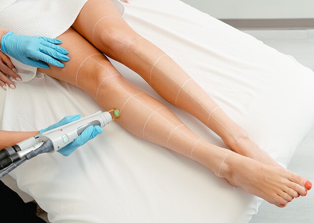 Aerial shot of a woman with white grid lines drawn on her legs being lasered by a Milan laser professional