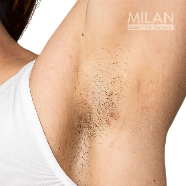 Model 3 before underarm laser hair removal