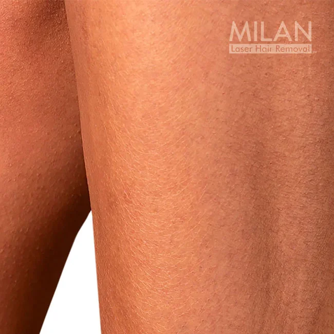 After image of a Milan client after leg laser hair removal