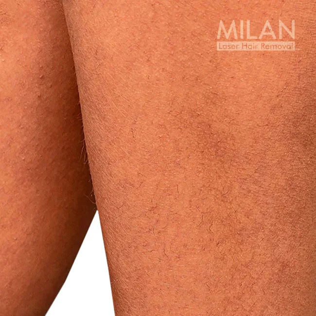 Before image of a Milan client before leg laser hair removal