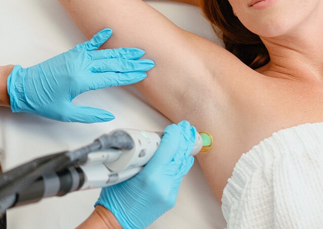 A woman wrapped in a white towel receives laser hair removal treatment on her underarms from a Milan Provider wearing light blue gloves in an image for a blog titled Laser Hair Removal Systems With Advanced Cooling and Ergonomic Designs.