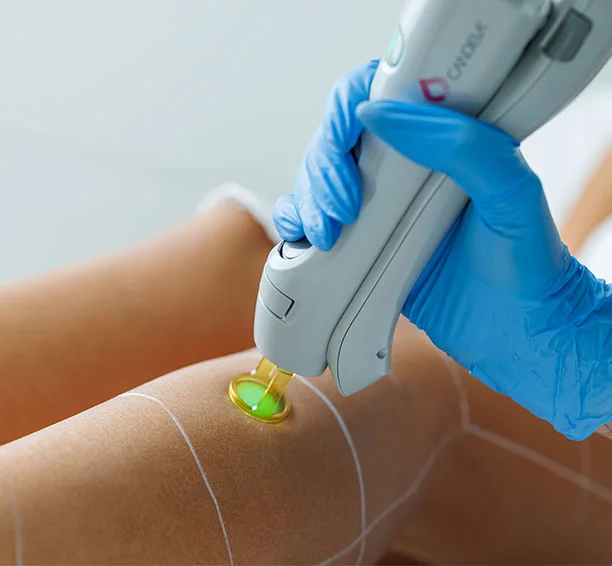 Close-up of leg laser hair removal being done by a blue gloved tech