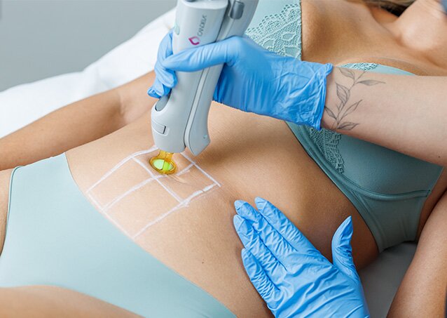 A woman wearing a light green top and bottom receives laser hair removal treatment on her stomach in an image for a blog titled Laser Hair Removal Pain Level.