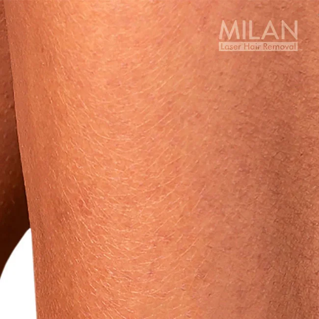After image of a Milan client after leg laser hair removal