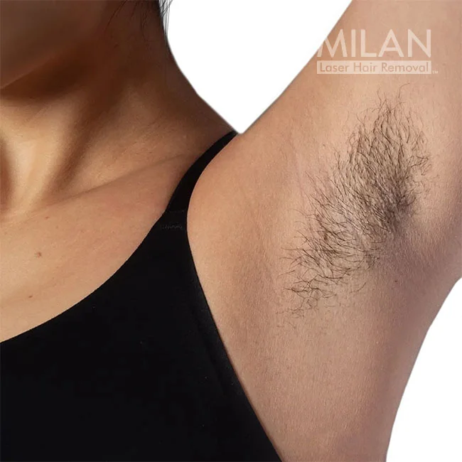 Model 1 before underarm laser hair removal
