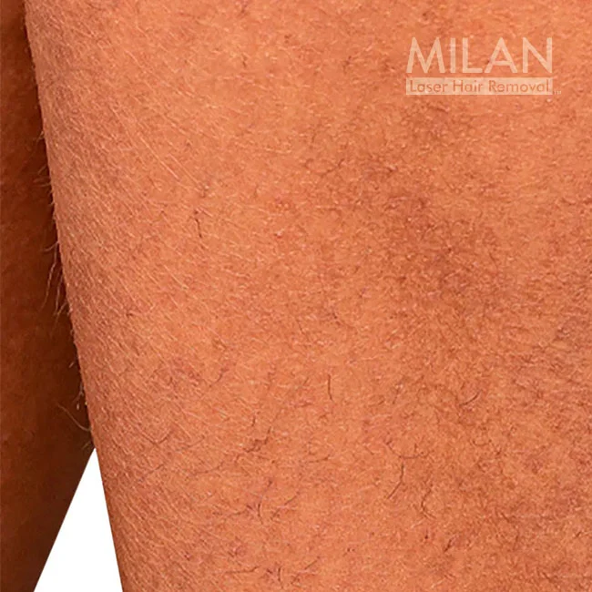 Before image of a Milan client before leg laser hair removal