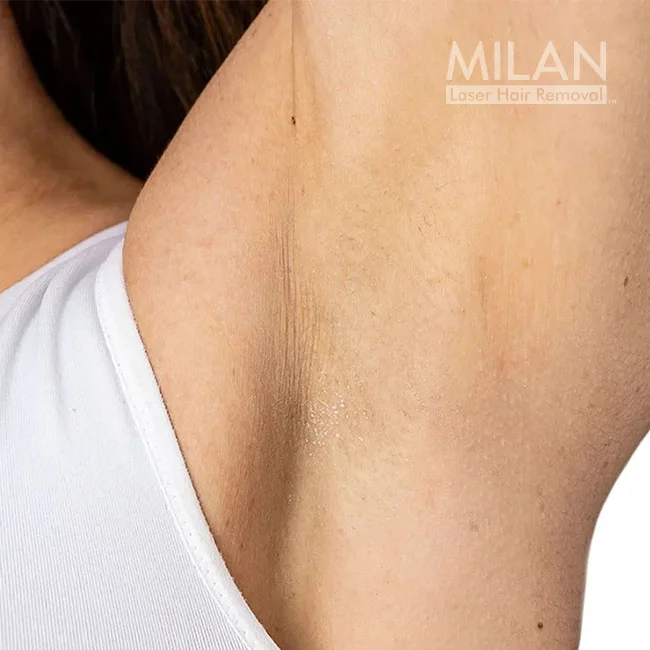 Model 3 after underarm laser hair removal