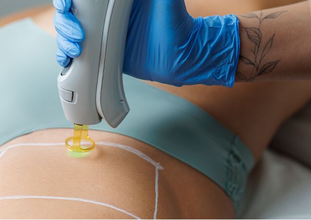 White grid lines drawn on a woman in teal undergarments that's getting treated on her bikini area with laser hair removal as an image for a piece on permanent pubic hair removal