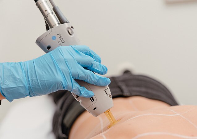 A Milan Laser Provider performs laser hair removal on a client’s back in an image for a blog titled Top FDA-Approved Laser Hair Removal Machines for Professional Use in the U.S.