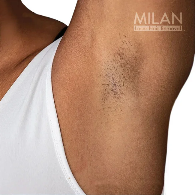 Model 2 before underarm laser hair removal