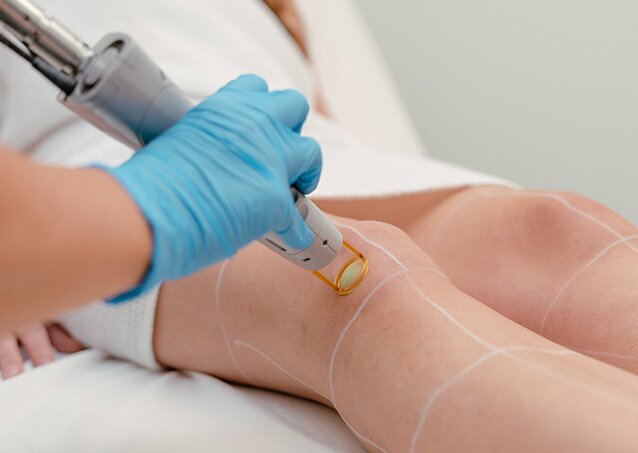 A woman wearing protective eyewear in a treatment room at Milan Laser gets laser hair removal on her chin for a blog titled Laser Hair Removal vs. Epilators.