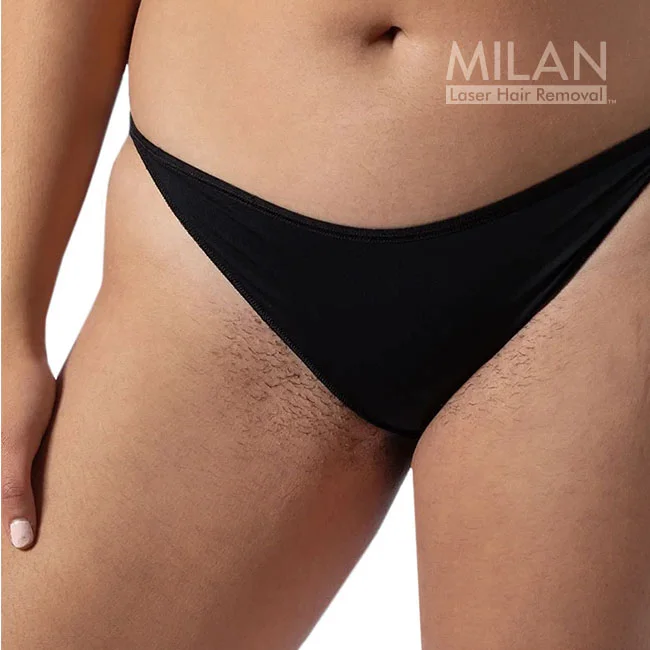 Close-up image of a woman who is about to get bikini laser hair removal