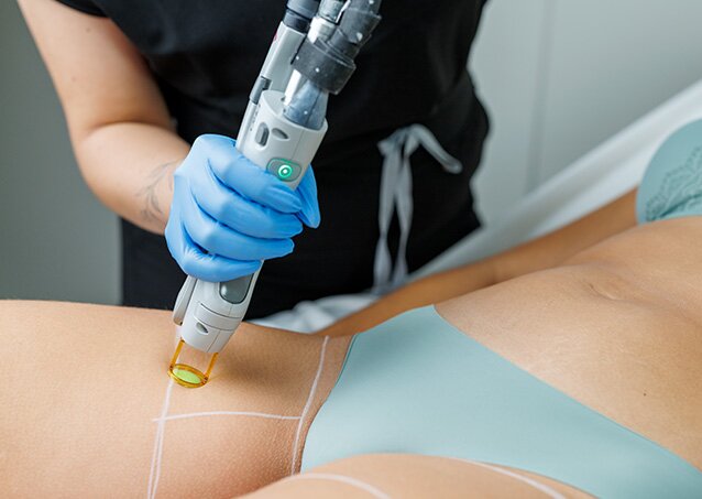 image of a laser treating a leg with a grid on it, woman in black scrubs with blue gloves, and a white room for a piece on how to get rid of ingrown pubic hair