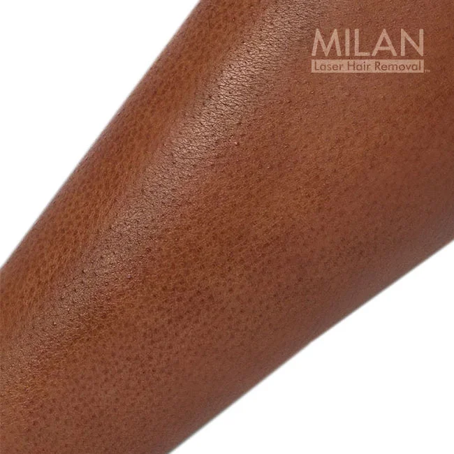 Before image of a Milan client before leg laser hair removal