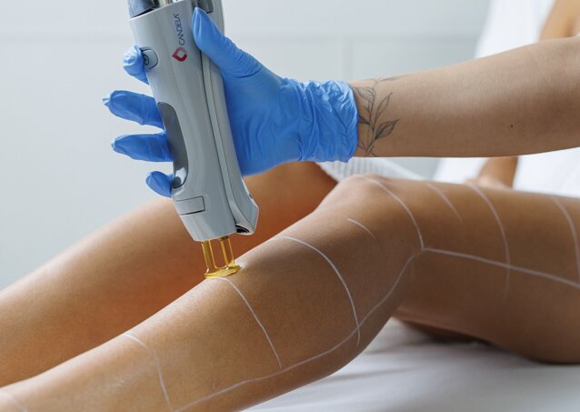 Woman getting laser hair removal on her legs from a laser tech in blue rubber gloves