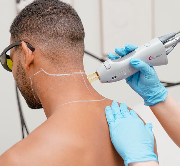 Guy getting the back of his neck laser hair removal treated by a tech in blue gloves