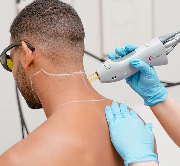 Guy getting the back of his neck laser hair removal treated by a tech in blue gloves
