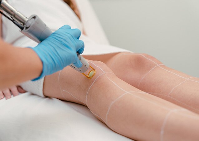 A woman wrapped in a towel receives laser hair removal treatment on her legs from a Milan Laser Provider in an image for a blog titled Laser Hair Removal Age: When Can Someone Start a Hair-Free Journey.