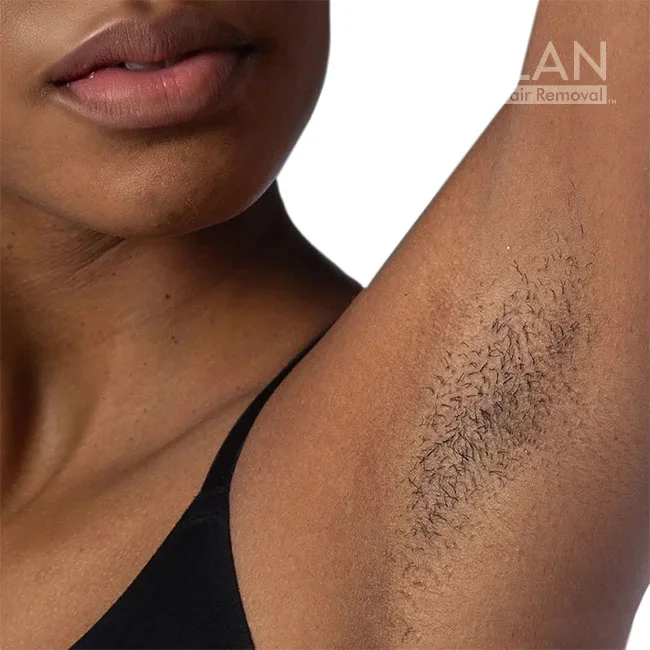 Model 4 before underarm laser hair removal