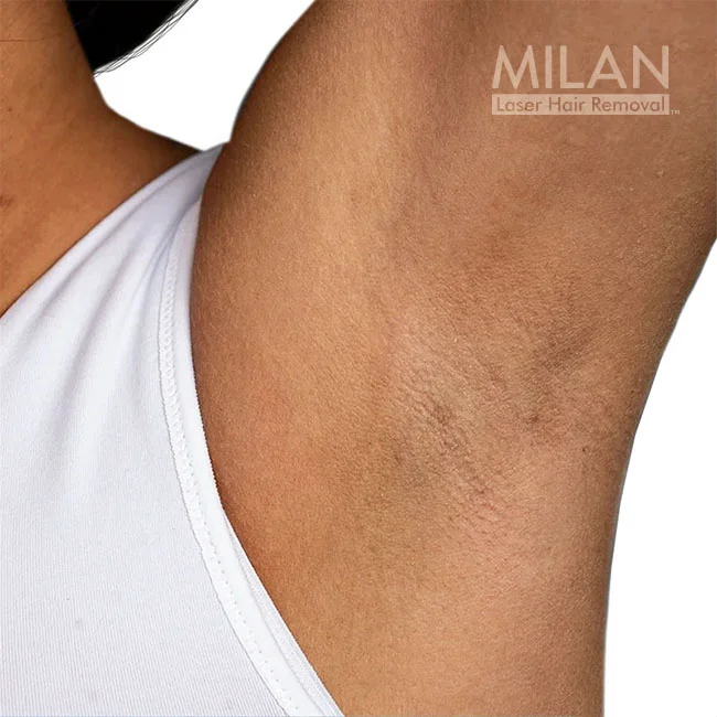 Model 2 after underarm laser hair removal