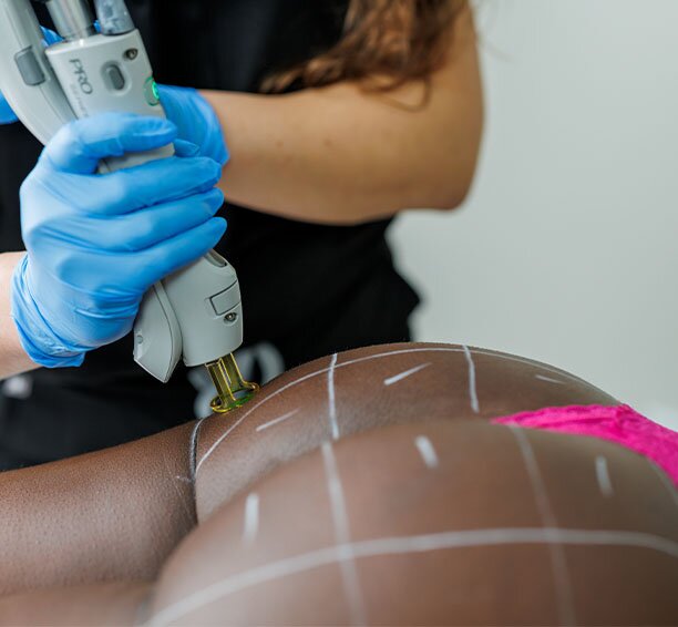 White gridlines on a woman's glutes being treated by Brazilian laser hair removal by a Milan Laser Hair Removal medical professional