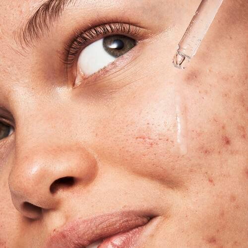 Model Applying Serum on Acne Prone Skin