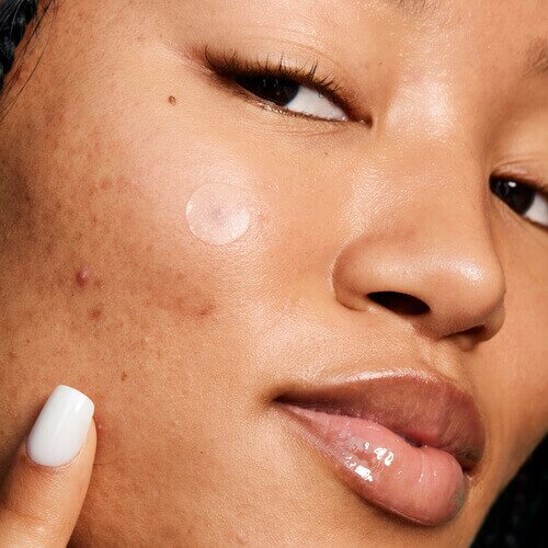 Model using Blemish Breakthrough Stick It to Zit Pimple Patches