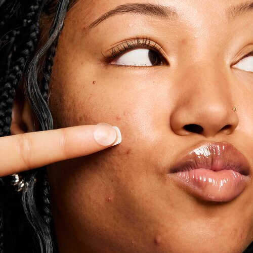 model applying hydrocolloid pimple patch to face