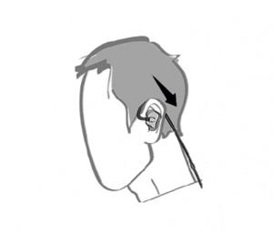 IEM insertion guide graphic