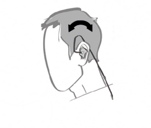 IEM insertion guide graphic