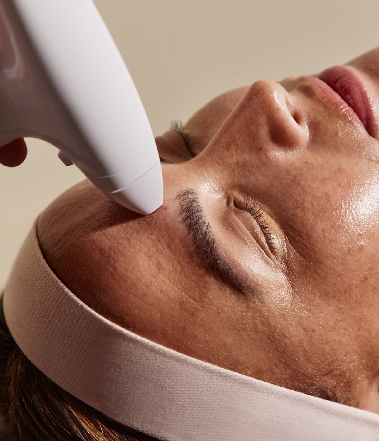 woman with acneic skin