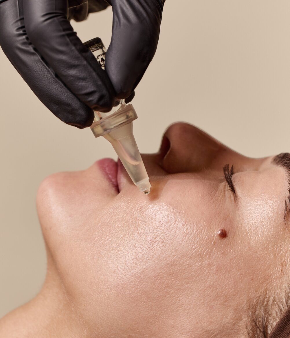 woman receiving a chemical facial peel