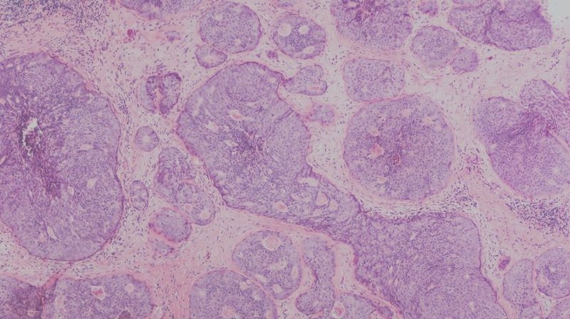 Fasting-mimicking diet and hormone therapy induce breast cancer regression